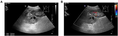 Case report: Pheochromocytoma complicated by type B aortic dissection